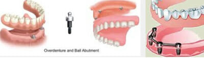 Implant Supported Dentures